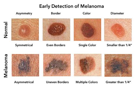 advanced melanoma symptoms signs